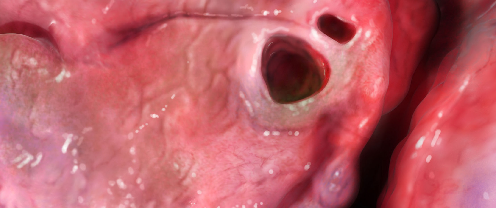 cystic banner